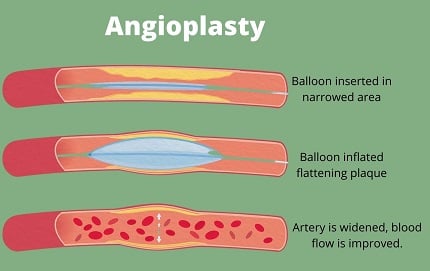 Angioplasty