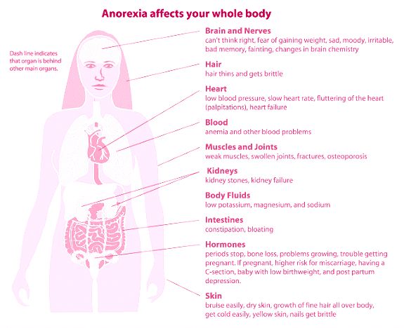 Anorexia Nervosa