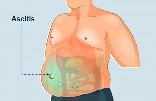 ascites ascites