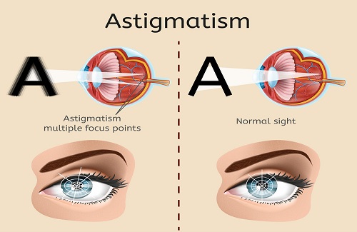 astigmatism astigmatism