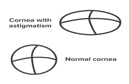 astigmatism astigmatism