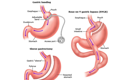 Bariatric surgery Bariatric surgery