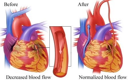Before and After Bypass Surgery