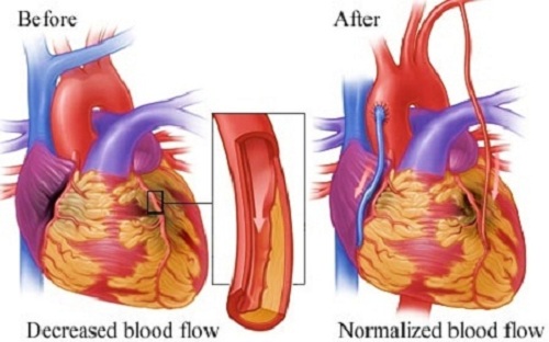 coronary artery bypass surgery coronary artery bypass surgery