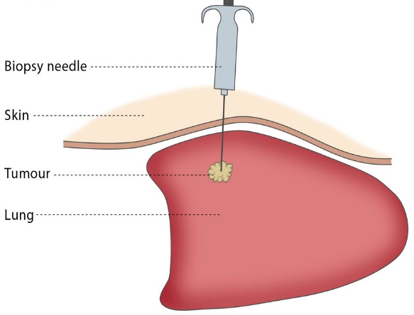 Biopsy