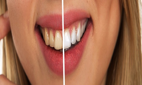 bleaching of teeth bleaching of teeth