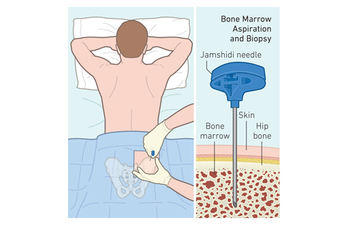 Donating bone marrow cells