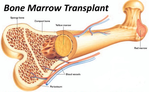 bone marrow transplant bone marrow transplant