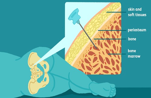 how bone marrow transplant works how bone marrow transplant works