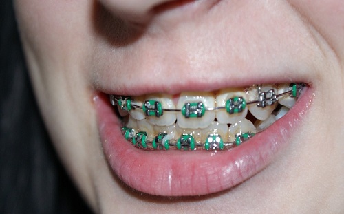 orthodontic braces orthodontic braces