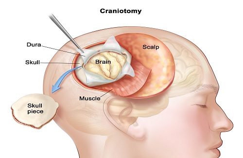 brain tumor surgery brain tumor surgery