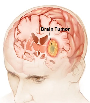 Brain Tumour