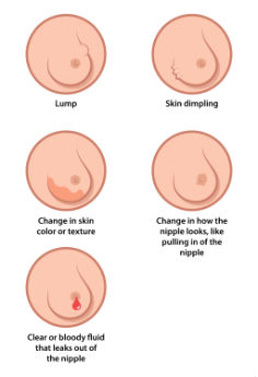 Breast Cancer