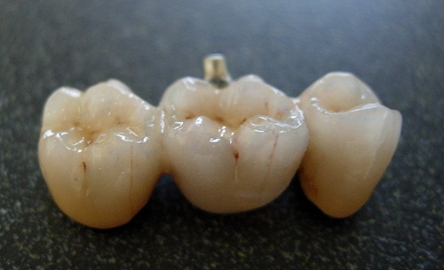 dental bridge dental bridge