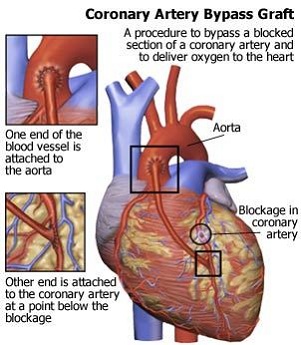 Coronary Artery Bypass Grafting Coronary Artery Bypass Grafting