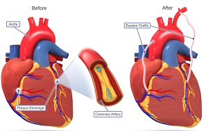 CABG