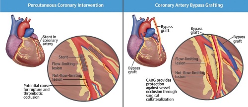 Coronary artery bypass surgery Coronary artery bypass surgery