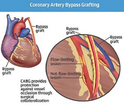 Coronary Artery Bypass Surgery Coronary Artery Bypass Surgery