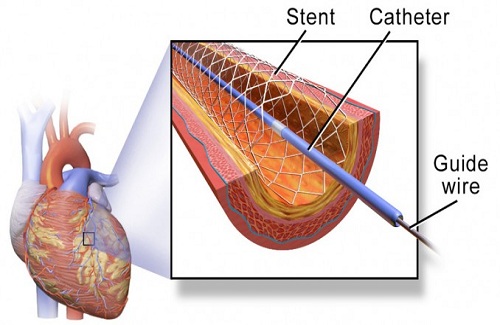 coronary artery bypass surgery coronary artery bypass surgery