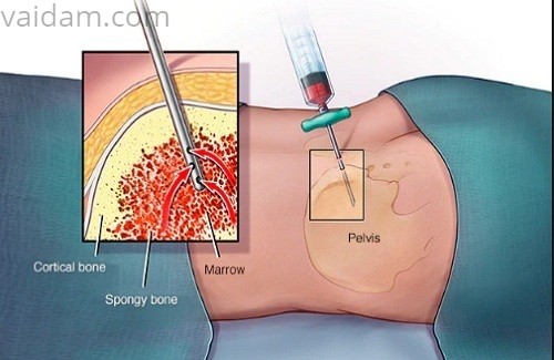 Bone Marrow Transplant Bone Marrow Transplant