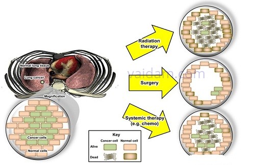 types of cancer treatment types of cancer treatment