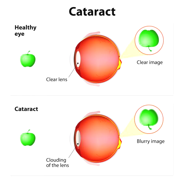Cataract