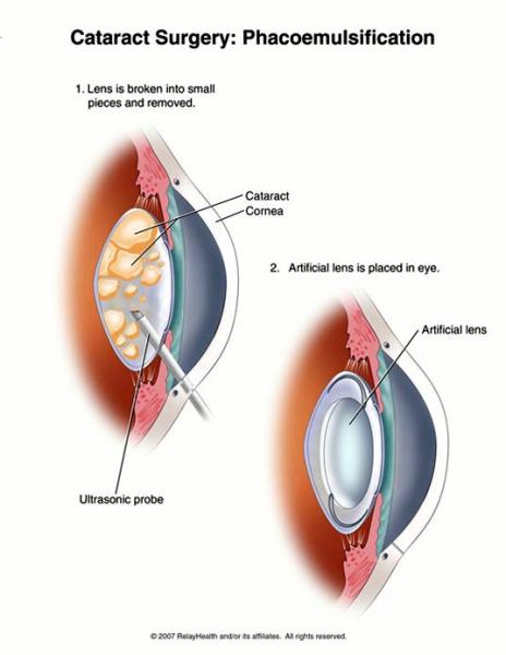 Cataract Surgery Procedure