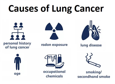 Causes of Lung Cancer