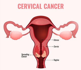 Cervical Cancer