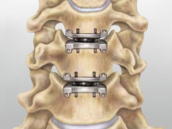 Cervical Disk Replacement Surgery