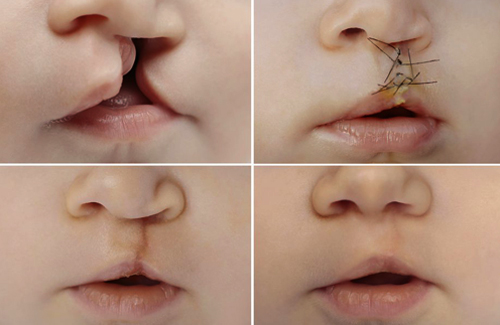 cleft lip and cleft palate cleft lip and cleft palate