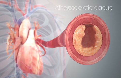 atherosclerosis atherosclerosis