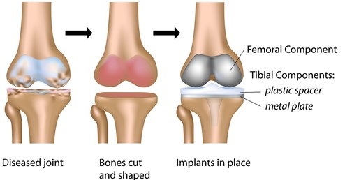 knee arthroplasty