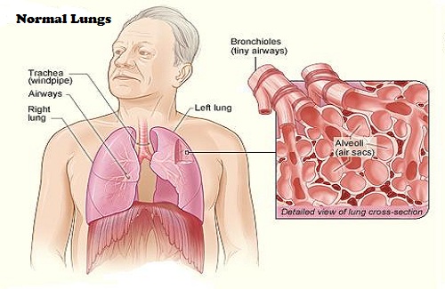 COPD means Chronic Obstructive Pulmonary Disease. As per the studies conducted by WHO (World Health Organization), nearly 65 million people suffer from moderate to severe form of COPD. More than 3 million people have died due to COPD in 2005, which was 5% global deaths. It is estimated that COPD is going to be the 3rd leading cause of the worldwide deaths. What is Chronic Obstructive Pulmonary Disorder? COPD is a relatively wider term used to describe the progressive lung diseases including emphysema, chronic bronchitis, asthma. The most significant character of this condition is breathlessness. Emphysema - This is a condition in which the tiny air sacs of the lungs are damaged. The walls are stretched, increasing the size of the lungs and making it harder for air to move in and out. The inhaled air gets trapped inside the alveoli for a long time such that the next time you inhale more air cannot get into the alveolar sacs. Chronic bronchitis - This is caused by inflammation of the breathing tubes in the lungs. The cilia (tiny hair-like structure that keep the airways clean) are damaged making the airways swollen and clogged. This limits the airflow in and out of the lungs. Refractory or non-reversible asthma - This kind of asthma do not respond well to the medications. The airways get permanently tighten and swollen up. What causes COPD and what are the risk factors? Inhaling pollutants - Most of the COPD cases happen due to tobacco smoking such as cigaretter, pipes, cigars etc. and second-hand smoking. Though everybody who smokes does not get COPD, most of the COPD cases have a smoking history. COPD most commonly occurs in people with 40 years of age or above. Environmental fumes - People with long term exposure to harmful pollutants in the workplace including lung irritants, chemicals, dust or fumes can cause COPD. Also, long term exposure and contact with secondhand smoke or other lung irritants at home like cooking fuel can also COPD. Genetic causes - The most common genetic risk factor for emphysema is Alpha-1 Antitrypsin Deficiency. The deficiency causes harm to the lungs with White Blood Cells. Signs and symptoms Most common signs and symptoms of COPD include, Tightness in the chest Wheezing Short breath Chronic cough with mucus Cyanosis of lips or fingernail beds Frequent respiratory infections Post nasal drainage Unintended weight loss Fatigue Swelling in ankles,feet or legs Diagnosis of COPD When you approach a pulmonologist, he/she will take a detailed case history. It is important to tell your doctor about all your past illnesses, family history and any other medical information. Following tests are also advised to diagnose COPD that include: Lung Function Test - This test measures the amount of air the lungs can inhale and exhale and if the lungs are delivering enough oxygen to the blood. Spirometry - This is a widely used test. The patient is asked to blow into a large tube connected to a small machine known as spirometer. This measures the amount of air the lungs can hold and the speed with which the air can be blown out of the lungs. Spirometry is used to track the progression of the disease and it can also diagnose COPD even before it manifests the symptoms. Chest X-ray - This helps in diagnosing emphysema, one of the main causes of COPD. A chest x-ray also helps to rule out lung problems and heart failure. CT scan - This is used to detect emphysema and also check if surgery is required. Other than this, CT scan is also used to diagnose the lung cancer. Arterial blood gas analysis - This tests the ability of the lungs to bring oxygen in the blood and remove carbon dioxide. Laboratory tests - Certain lab tests are used to check if there is any deficiency of alpha-1-antitrypsin deficiency which may be a cause of COPD. This is usually done if a person has a family history of COPD. How is COPD treated? Quit smoking - This is the most imperative step in treating COPD. The patient must take the help of a doctor regarding nicotine replacement products and medications. Medications Following type of medications are usually recommended to the patients by the doctors. These are listed below: Inhalation steroids - Sometimes, the doctors prescribe corticosteroids medications to reduce the inflammation in the airways. These medications help in frequent aggravation of the symptoms. A few examples are fluticasone and budesonide. Bronchodilators - The bronchodilators help in the relaxation of muscles of the respiratory airways. As a result, symptoms like shortness of breath and cough are relieved. Bronchodilators are either short-acting such as albuterol, levalbuterol, ipratropium etc or long-acting like salmeterol, formoterol, indacaterol etc. Antibiotics - The infectious diseases like bronchitis, pneumonia, and influenza are treated with the help of antibiotics. This is done to prevent the exacerbations of COPD. Breathing therapies These include oxygen therapy which includes providing supplementary oxygen to assist the patient in breathing. Depending upon the severity of the illness, the oxygen supplementation can be used all the time or while doing physical activity and while sleeping. The other therapy is known as the Pulmonary rehabilitation program which includes a combination of counseling, exercise, nutrition and education done by a team of specialists as per your needs. Surgical options Bullectomy - There are large spaced formed in the lungs when the air sacs gets destroyed. The spaces are very large and makes breathing difficult. Bullectomy involves removal of these spaces to improve the airflow. Lung Volume Reduction Surgery - The damaged portion in the upper part of the lungs is removed to create an extra space in the chest cavity for the rest of the lung to expand. The diaphragm also works more efficiently. Lung Transplant - This is the ultimate surgical option for cases where the entire lung has been damaged. However, according to some of the best pulmonologists in India, the surgery has high risks and complications such as immune organ rejection by the body. appearance of normal lungs