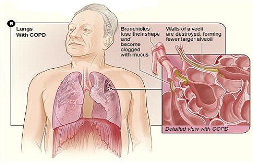 appearance of lungs with COPD appearance of lungs with COPD