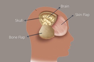 Craniotomy