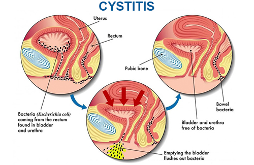 Interstitial cystitis Interstitial cystitis