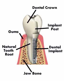Dental Implant