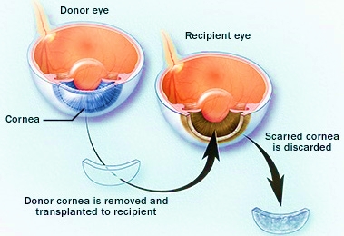During Corneal Surgery