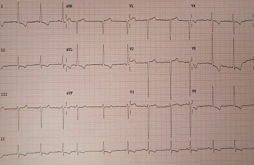 ECG test cost - Vaidam ECG test cost - Vaidam