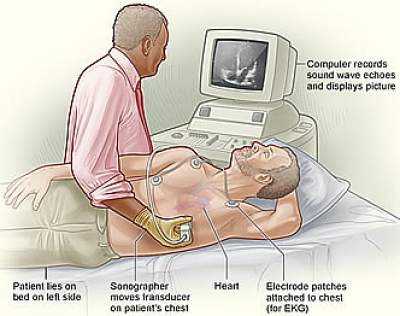 Echocargiography