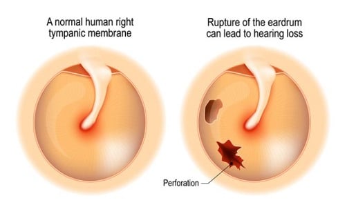 Chronic suppurative otitis media