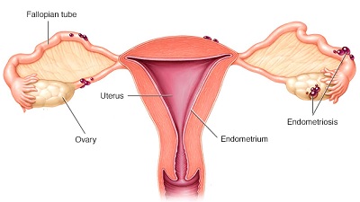 Endometriosis