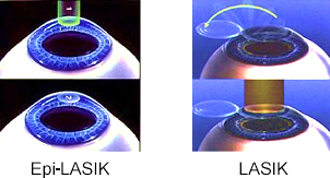 Epi-LASIK