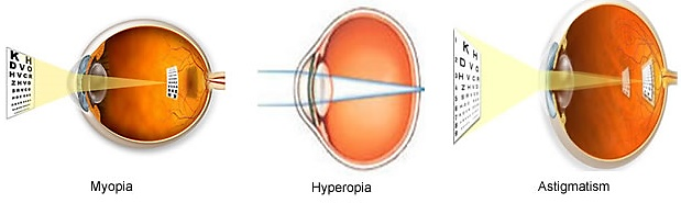 Refractive Errors 