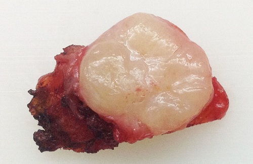 How to dissolve fibroadenoma How to dissolve fibroadenoma
