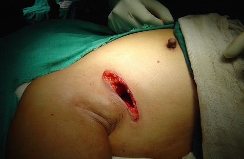 How to dissolve fibroadenoma How to dissolve fibroadenoma