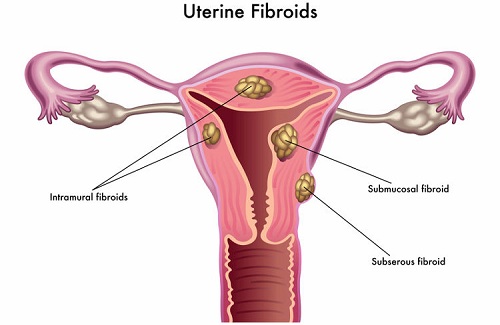 types of uterine fibroids types of uterine fibroids