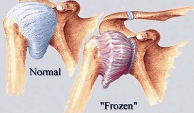 Frozen Shoulder