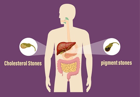 Gallstones